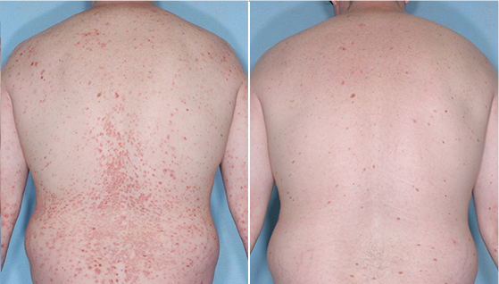 clinical studies show great benefits of Otezla treatment on back affected by psoriasis, otezla before and after