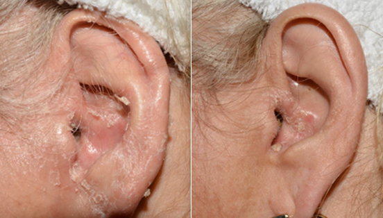 clinical studies show great benefits of Otezla treatment on ear psoriasis, otezla before and after