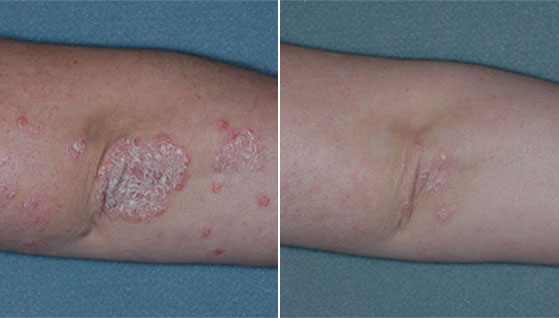 clinical studies show great benefits of Otezla treatment on elbows affected by psoriasis, otezla before and after