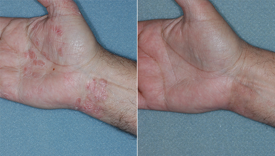clinical studies show great benefits of Otezla treatment on hand psoriasis, otezla before and after