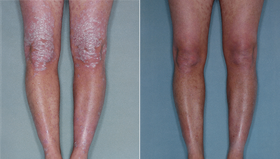 clinical studies show great benefits of Otezla treatment on legs affected by psoriasis, otezla before and after