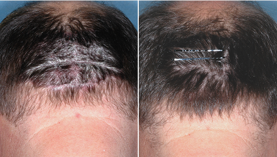 clinical studies show great benefits of Otezla treatment on scalp psoriasis, otezla before and after
